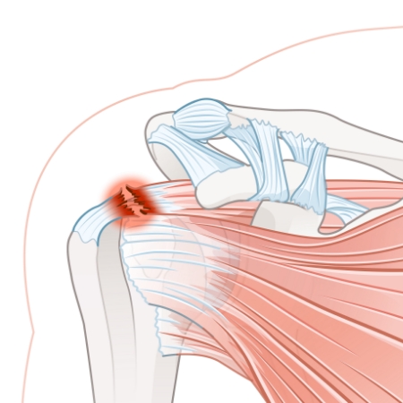 Monarch-Physiotherapy-Clinic-Calgary-AB