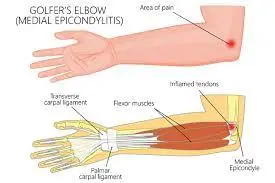 Golfers-Elbow