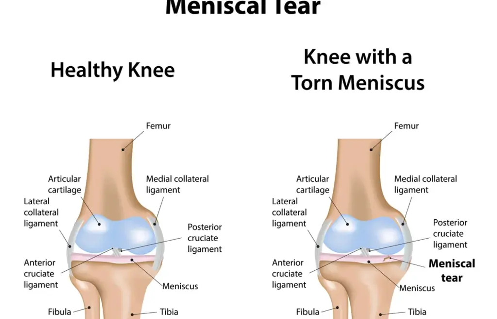 Meniscal-Tear
