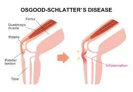 Osgood-Schlatter-Disease