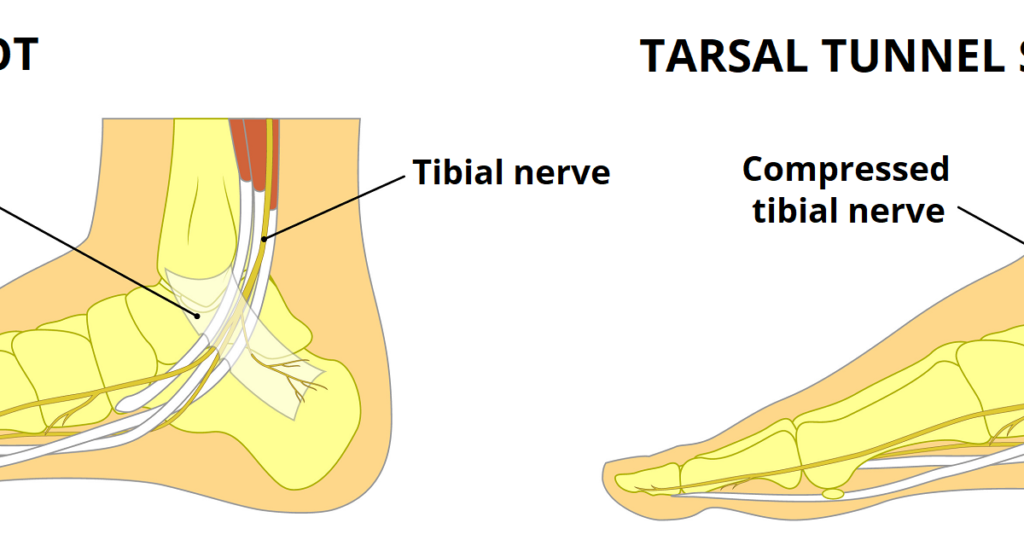 Tarsal-Tunnel-Syndrome