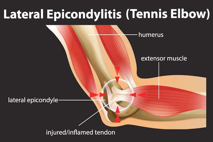 Tennis-Elbow