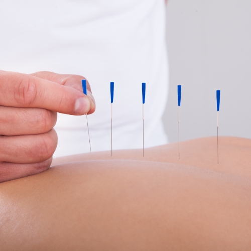 Dry-needling-monarch-physiotherapy-clinic-calgary-ab