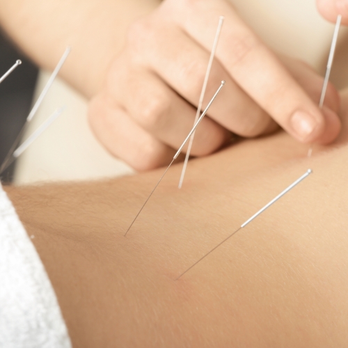 acupuncture-monarch-physiotherapy-clinic-calgary-ab