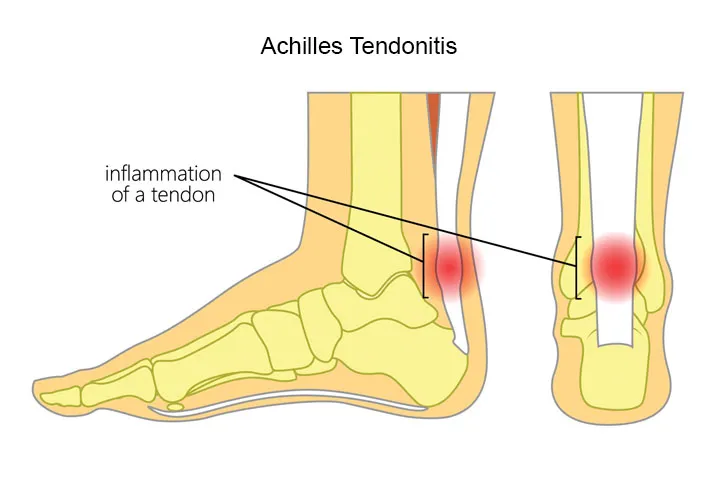 achilles-tendonitis-injury
