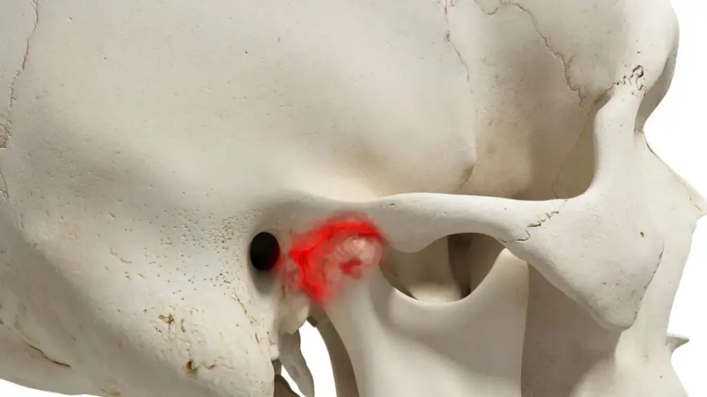 Finding Relief for your Jaw Pain: TMJ Dysfunction