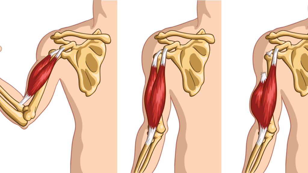 Physical Therapy Treatment for Biceps Tendonitis